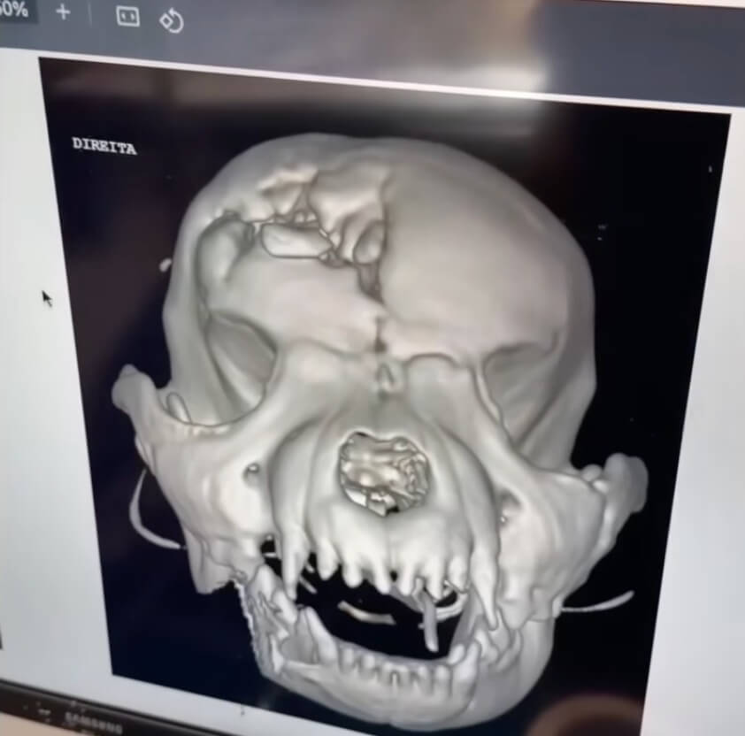 Valentina's CT scan